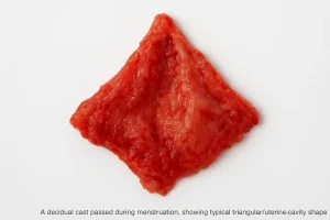 A decidual cast passed during menstruation, showing typical triangular/uterine-cavity shape.