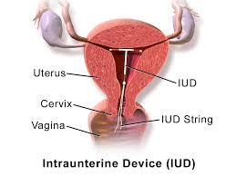 decidual cast iud