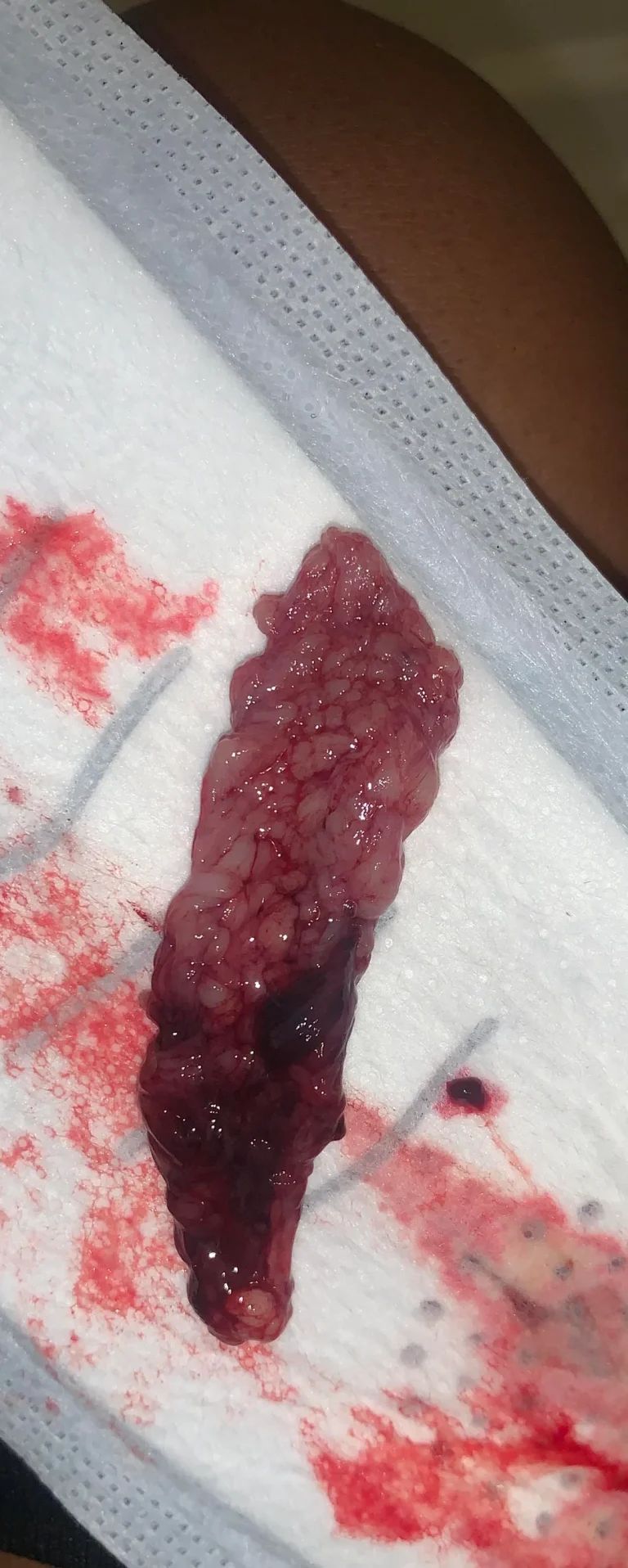 Decidual cast expelled intact uterine lining