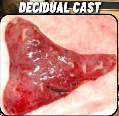 decidual cast photo