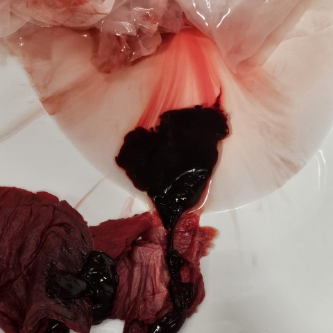 Blood clot or decidual cast