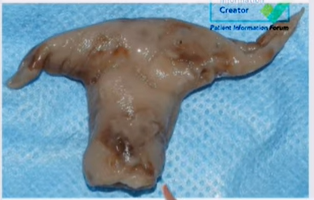 decidual cast tissue