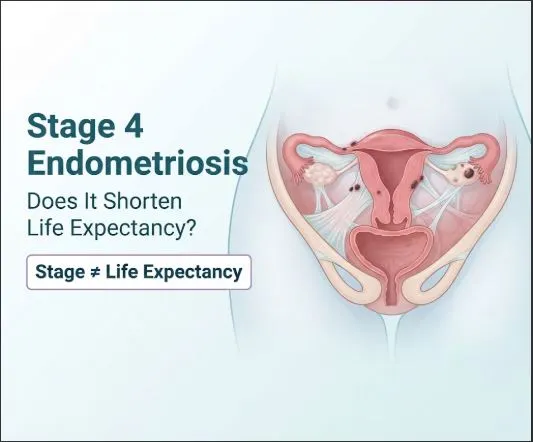 Stage 4 Endometriosis: Does It Shorten Life Expectancy?" showing a medical illustration of the female pelvis with uterus, ovaries, and endometriosis lesions, alongside a call-out box stating "Stage ≠ Life Expectancy