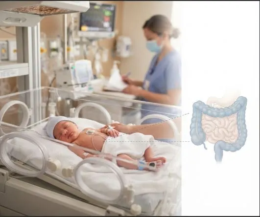 Premature newborn in NICU with an illustration of the intestines showing NEC